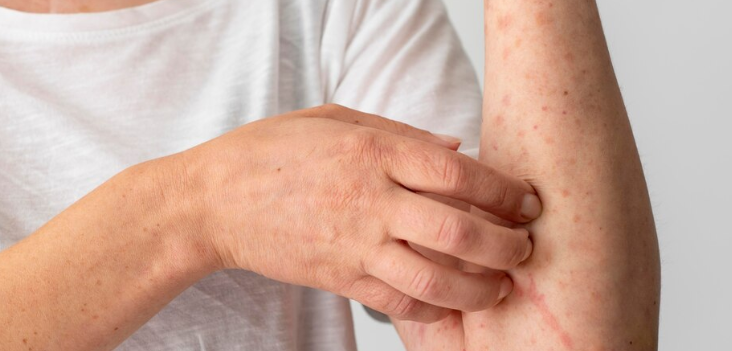NSW Health Issues Measles Alert After Infectious Person From Vietnam Lands in Sydney